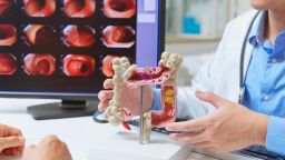 The shift in screening guidelines is associated with a recent increase in early-stage colorectal cancer diagnoses, but it does not explain the rise among younger adults in general.