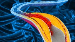 An illustration of an artery blocked by cholesterol blocked artery.