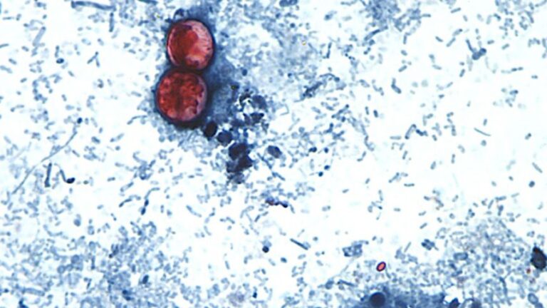 Cyclosporiasis is an intestinal infection caused by the cyclospora cayetanensis parasite. It's seen here on a stool sample through a microscope on a slide. The parasite is too small to see without the use of a microscope. Illness is caused by consuming food or drink that contains the parasite and usually takes about a week to make a person sick.