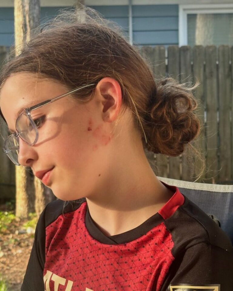 Anna Hand's daughter had burns on the side of her face after putting her NeeDoh toy in the microwave.