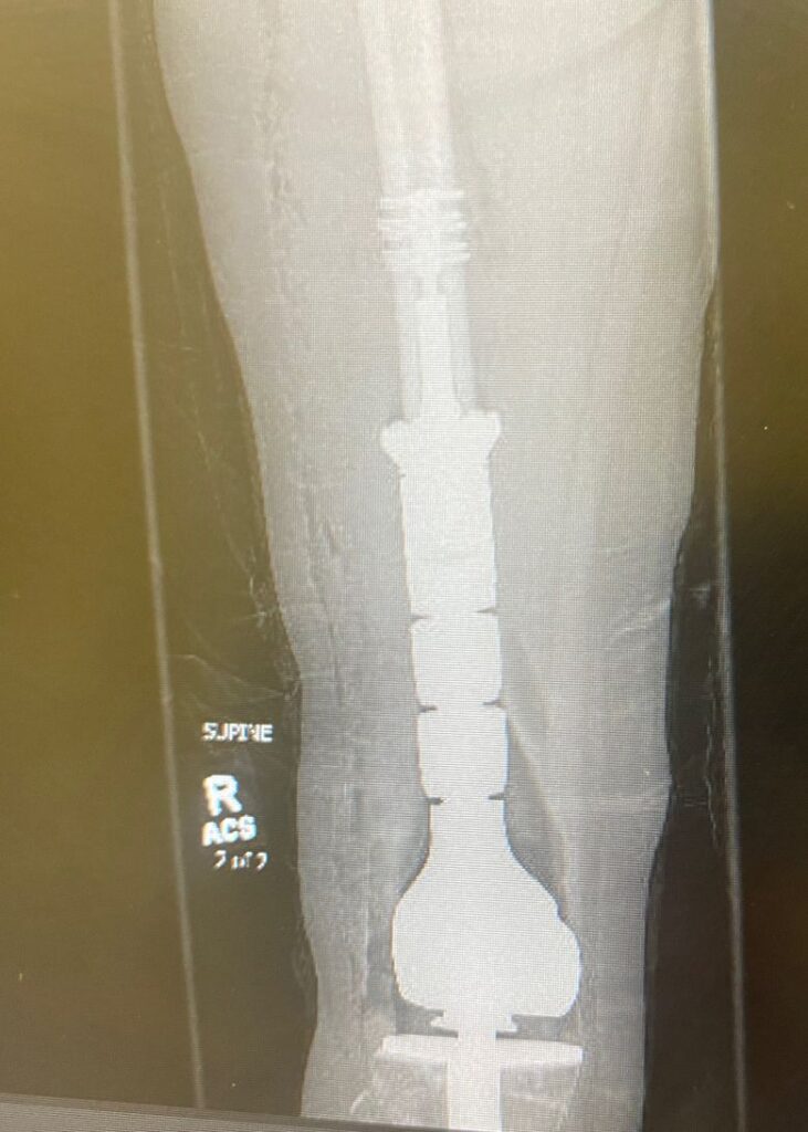Doctors inserted a metal prosthesis in Sabina’s right leg after removing a cancerous piece of bone.