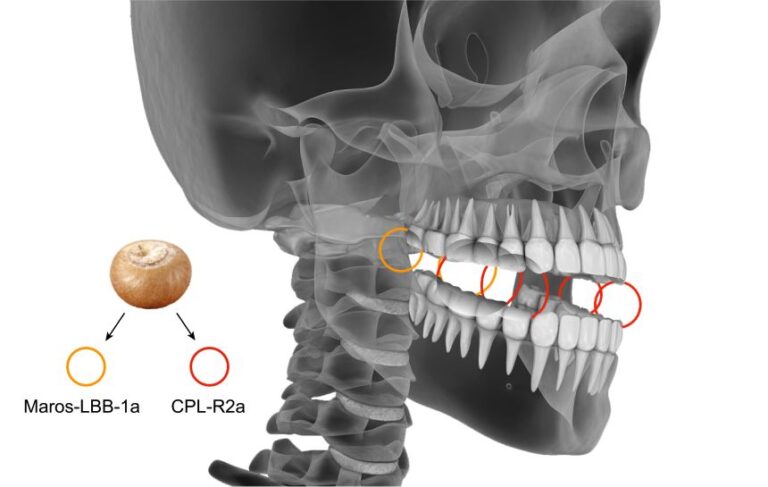 Circles indicate which teeth experienced wear from regular betel nut use.