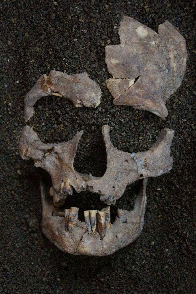 The teeth of a forager who lived between 7,600 and 6,300 years ago show signs of betel nut use.