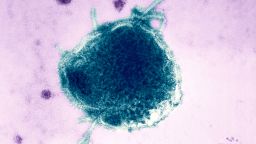 This Electron Micrograph Reveals Both A Paramyxovirus Measles Virus, And Virions Of The Polyomavirus, Simian Virus Sv40 Smaller Circles. The Envelope Of The Measles Virus Has Broken, Exposing The Nucleocapsid Filaments. Interest In Sv40 Has Increased In The Last Several Years Because The Virus Was Found In Certain Forms Of Cancer In Humans, For Instance Mesotheliomas Rare Tumors Located In The Lungs, Brain, And Bone Tumors Carbone Et Al. , 1994; Jasani Et Al. , 2001.