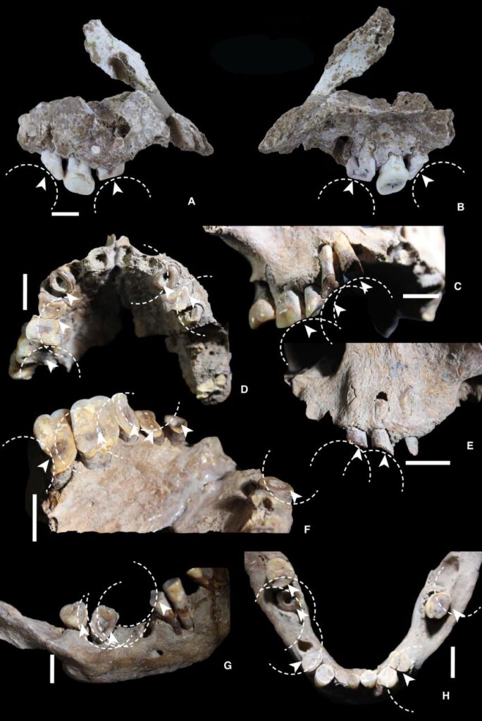 Deep grooves on the teeth suggest that the foragers developed a betel nut habit.