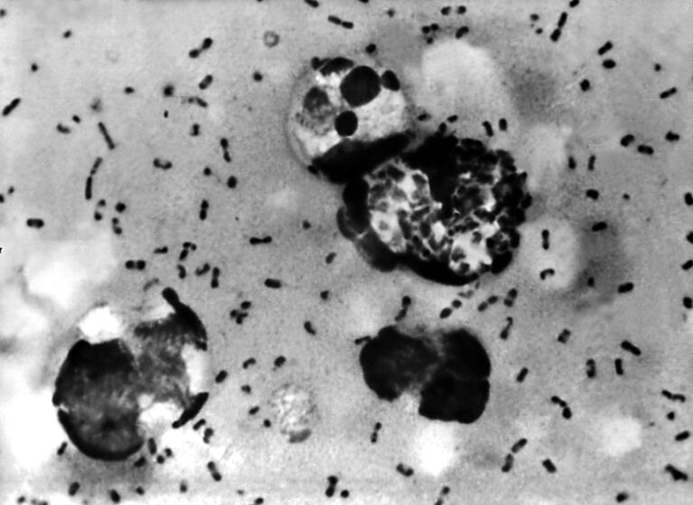 The bacteria Yersinia pestis causes plague, including the most common, bubonic plague, which typically results from the bite of an infected flea. Pneumonic plague is the most serious form of the illness.